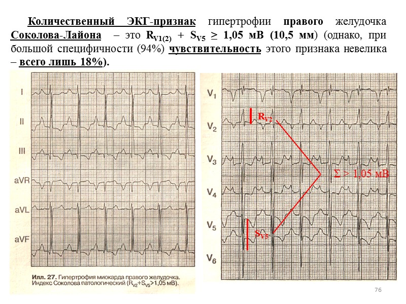 76 Количественный ЭКГ-признак гипертрофии правого желудочка Соколова-Лайона – 76 Количественный ЭКГ-признак гипертрофии правого желудочка Соколова-Лайона –